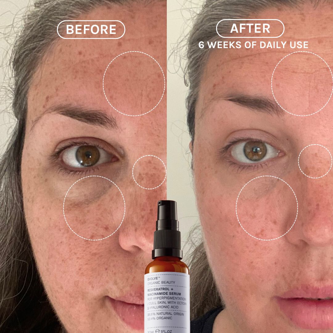 before and after, sigificantly reduces age spots and hyperpigmentation 